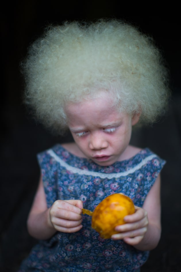 A very young albino girl peels fruit on Emirau Island, Papua New Guinea. © Simon Lister.