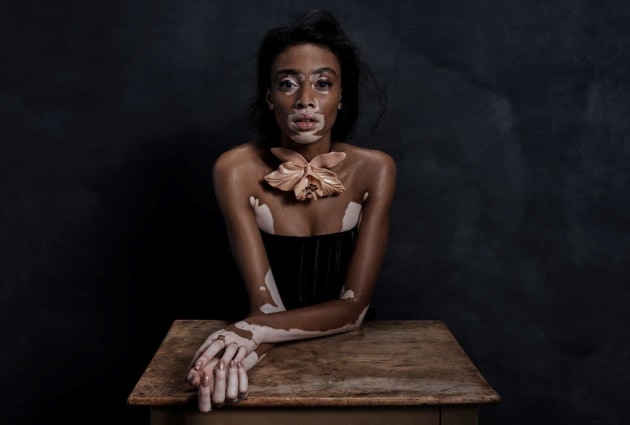 Winnie Harlow. © Hugh Stewart.
