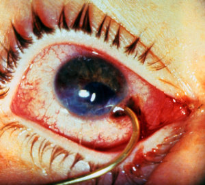 Fish hook eye Clearance